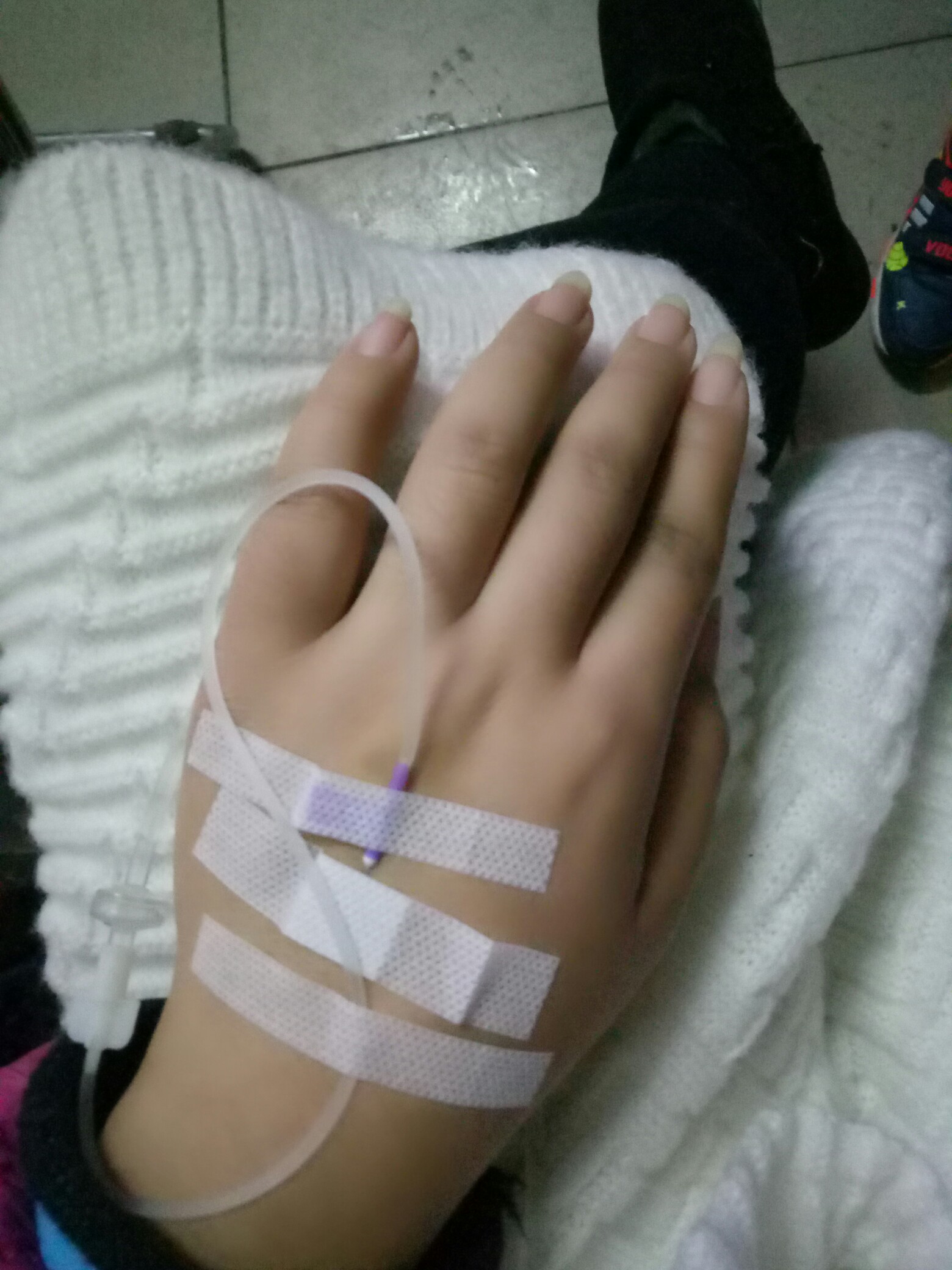 输完水,手总是肿的