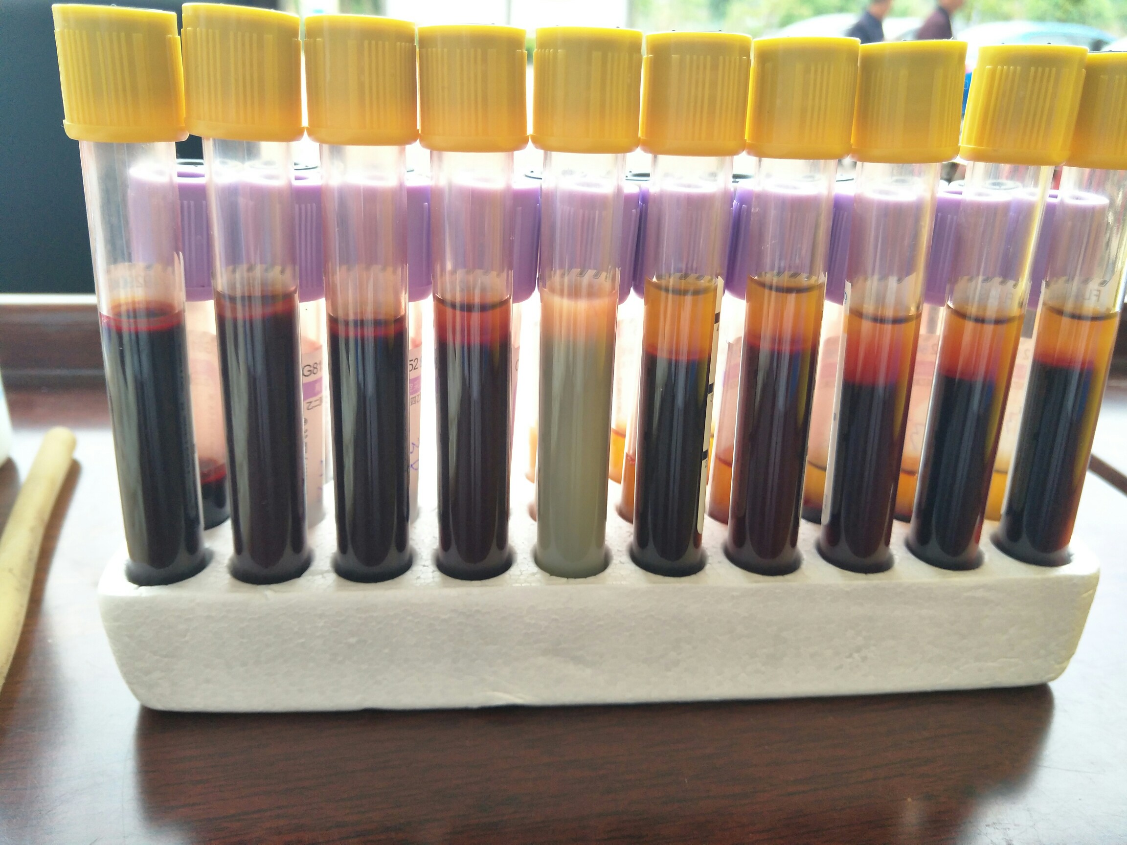 看到这管血,你就知道身体健康的重要性了!