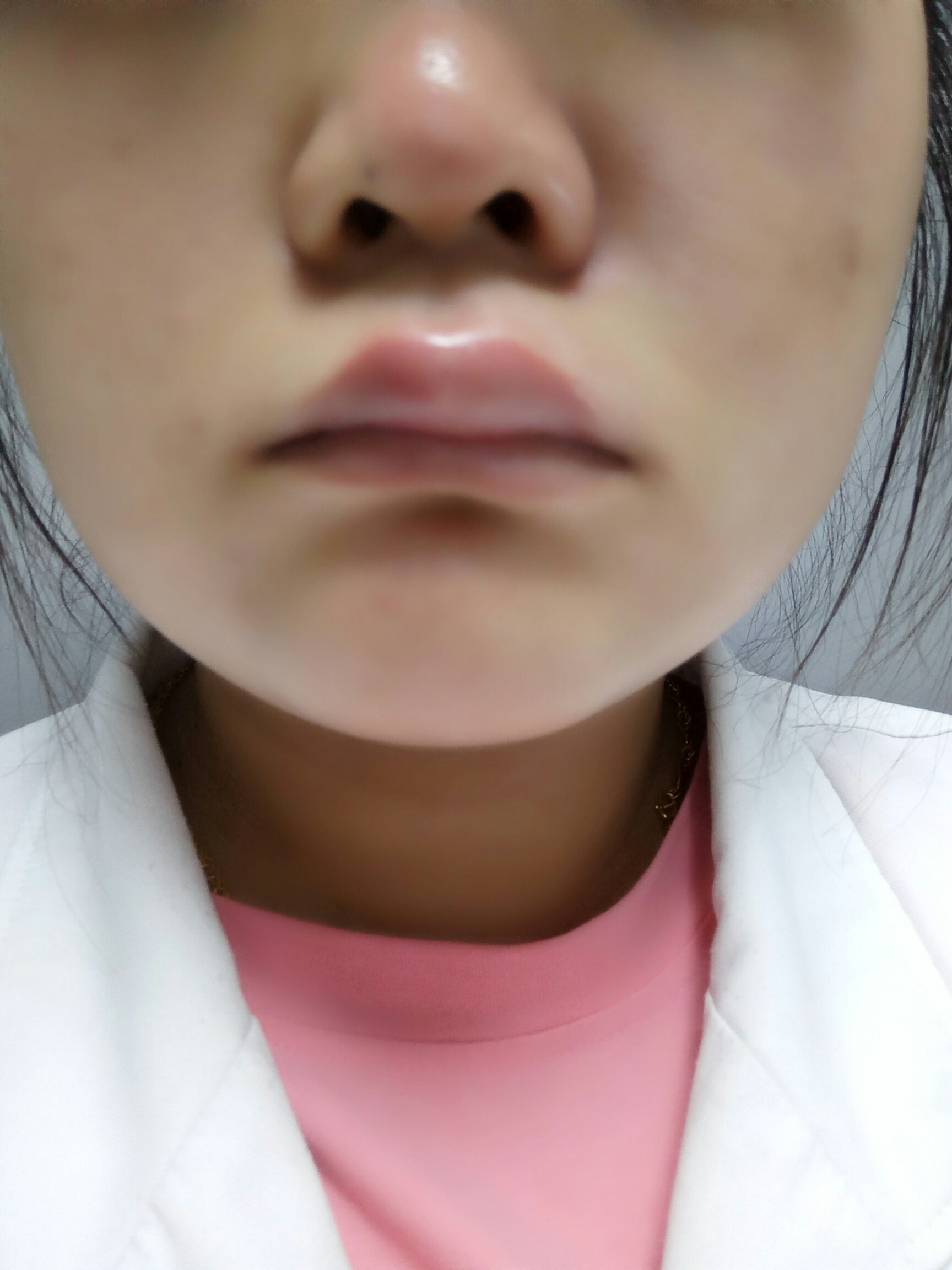 被蚊子咬肿了的嘴 可怜